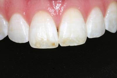 Brown Spot Removal Before and After - Sheridan Dental